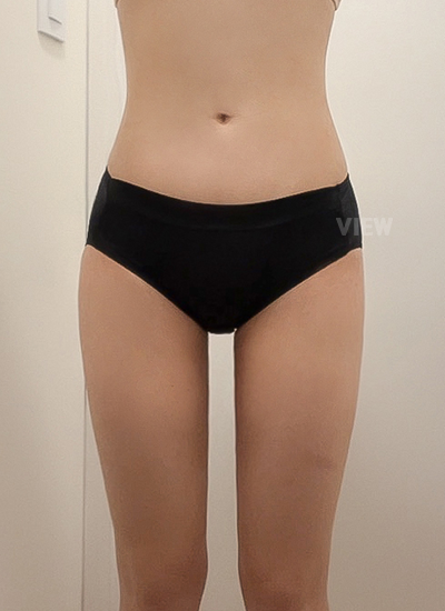 Liposuction 4 Months Post-surgery