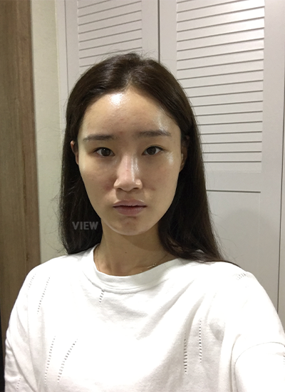 Korean woman before rhinoplasty