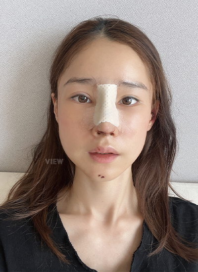 Korean woman putting splint on her nose after rhinoplasty