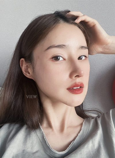  Woman one week after receiving rhinoplasty at a Korean plastic surgery clinic