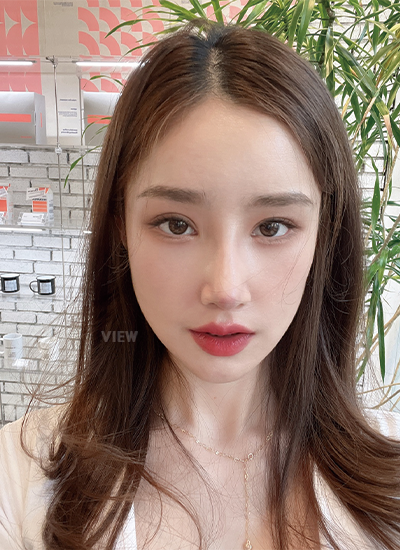 Woman two weeks after receiving nose job at a Korean plastic surgery clinic.