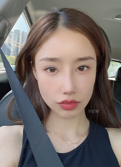 Woman three weeks after receiving rhinoplasty at a Korean plastic surgery clinic