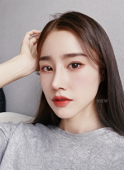 Woman one month after receiving rhinoplasty at a Korean plastic surgery clinic.