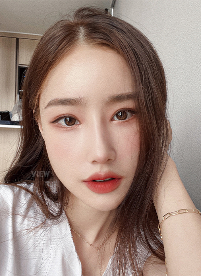 Woman two months after receiving rhinoplasty at a Korean plastic surgery clinic.