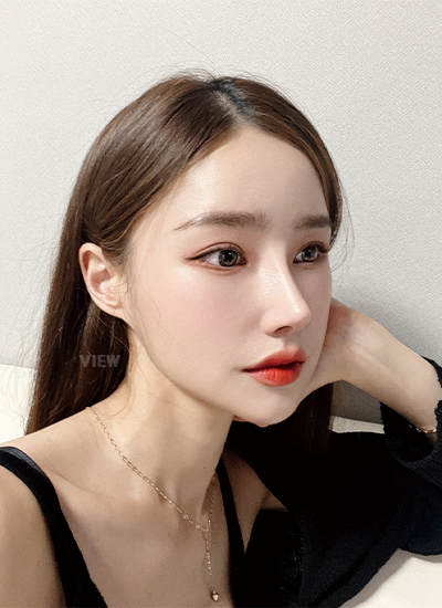 Woman two months after receiving rhinoplasty at a Korean plastic surgery clinic.