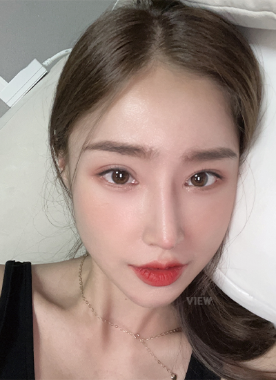 Woman three months after receiving rhinoplasty at a Korean plastic surgery clinic.