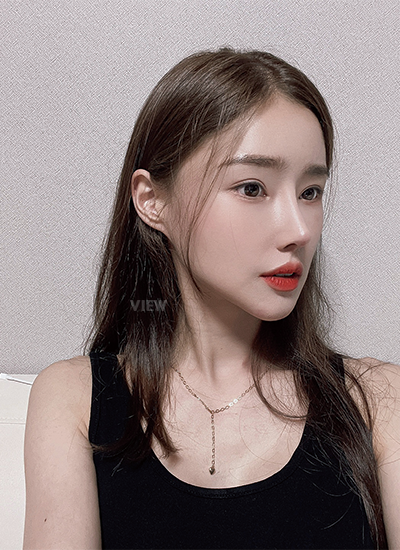 Woman three months after receiving rhinoplasty at a Korean plastic surgery clinic.