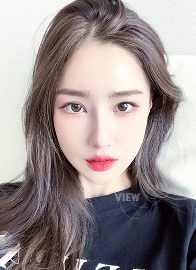 Woman four months after receiving rhinoplasty at a Korean plastic surgery clinic.