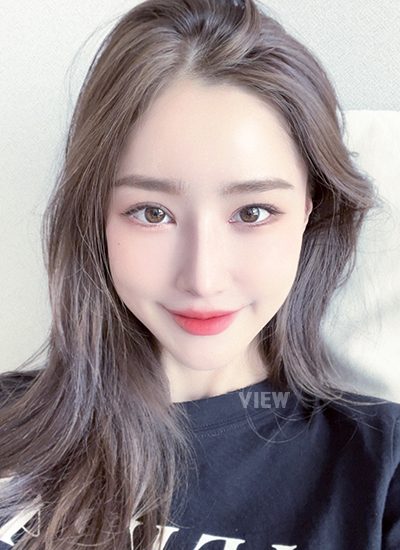 Woman four months after receiving rhinoplasty at a Korean plastic surgery clinic.