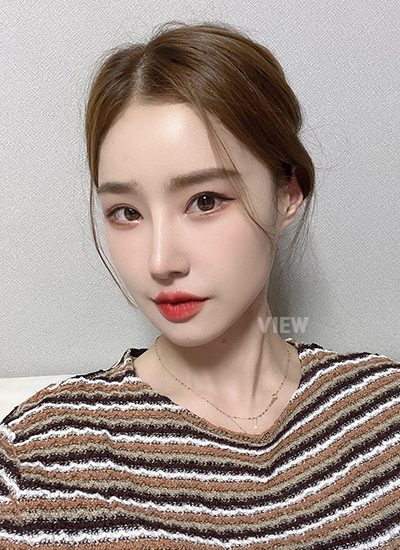  Woman five months after receiving rhinoplasty at a Korean plastic surgery clinic.