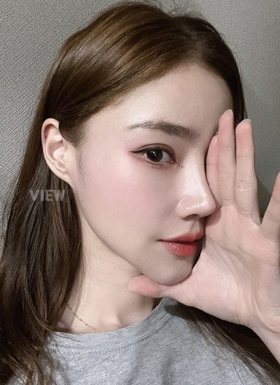 Woman five months after receiving rhinoplasty at a Korean plastic surgery clinic.