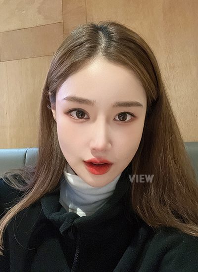 Woman six months after receiving rhinoplasty at a Korean plastic surgery clinic.