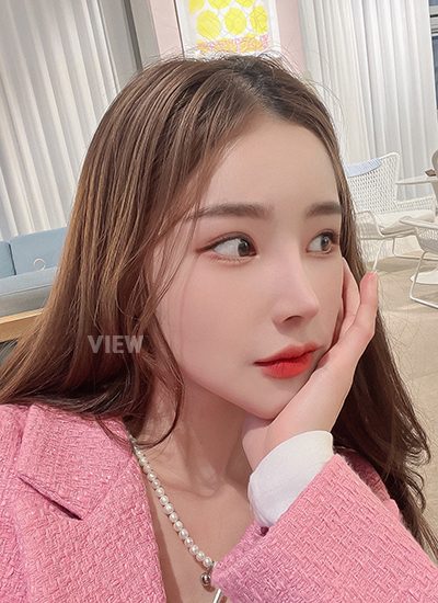Woman six months after receiving rhinoplasty at a Korean plastic surgery clinic.
