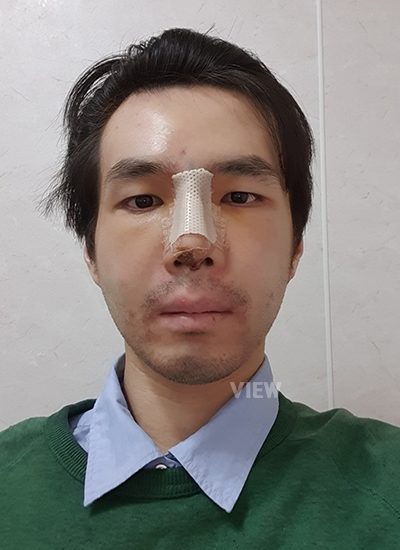 nose surgery swelling, male cosmetic surgery review