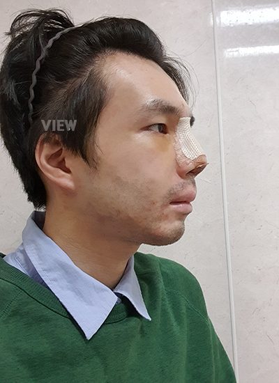 nose surgery swelling, male cosmetic surgery review