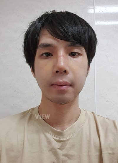 1 week review post male nose plastic surgery