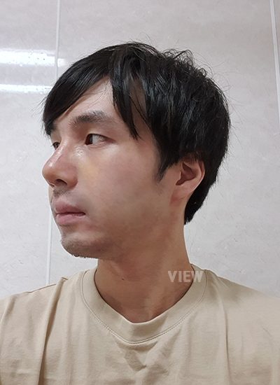 1 week review post male nose plastic surgery