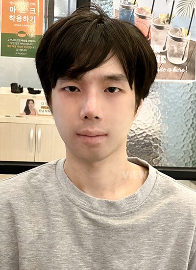 2nd week review of Male Nose Cosmetic Surgery 