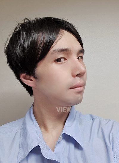 3rd week review post Male Nose Plastic Surgery