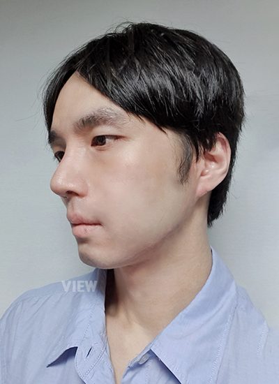 3rd week review post Male Nose Plastic Surgery