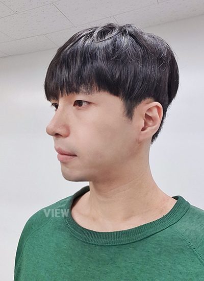 2 month review post male rhinoplasty