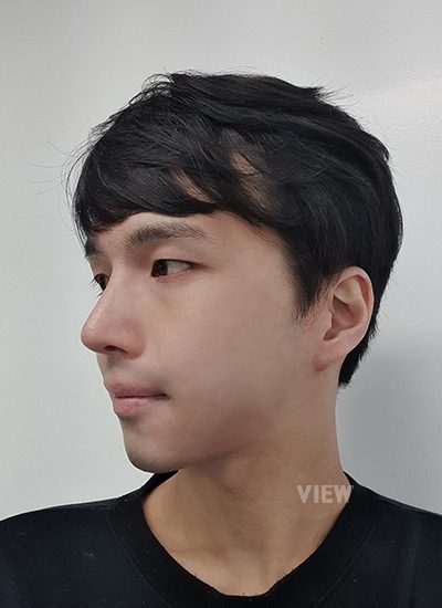 3 month review post male rhinoplasty