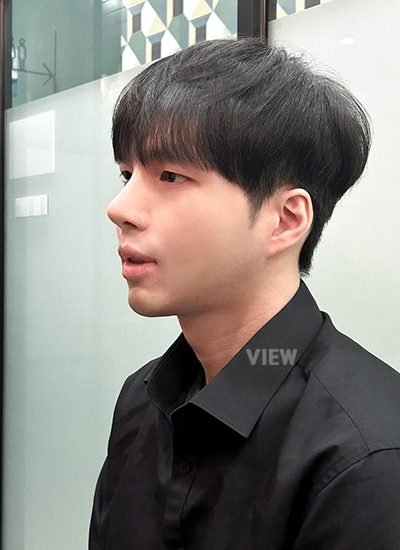 4 month review post male rhinoplasty