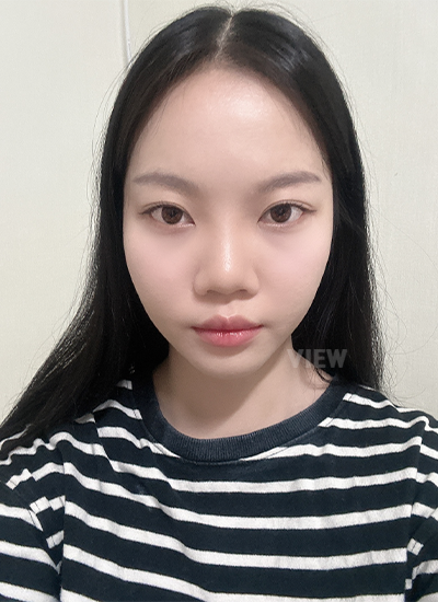 Woman before plastic surgery
