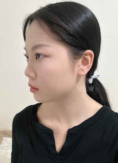 Woman before plastic surgery
