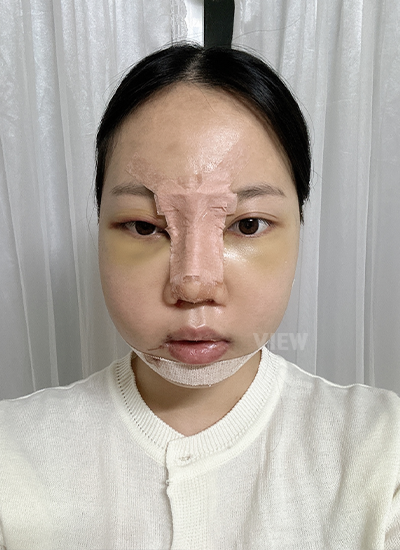 After 4 days plastic surgery