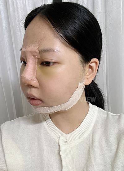After 4days plastic surgery