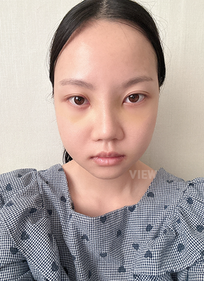 Woman 7 days after surgery