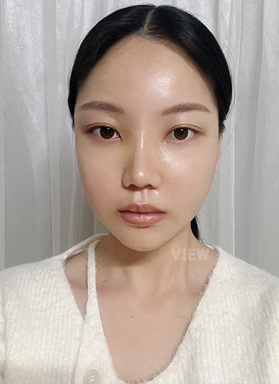 Appearance of a woman two weeks after surgery
