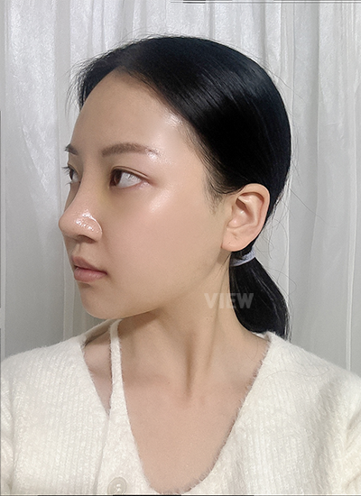Appearance of a woman two weeks after surgery