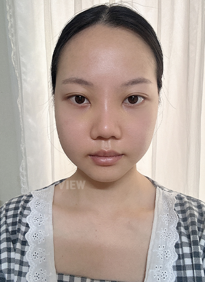 Appearance of a woman 3weeks after surgery