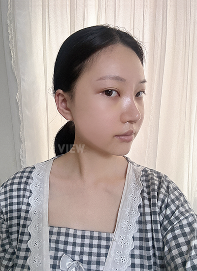 Appearance of a woman 3weeks after surgery