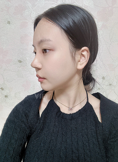 side view of a Korean woman who had rhinoplasty