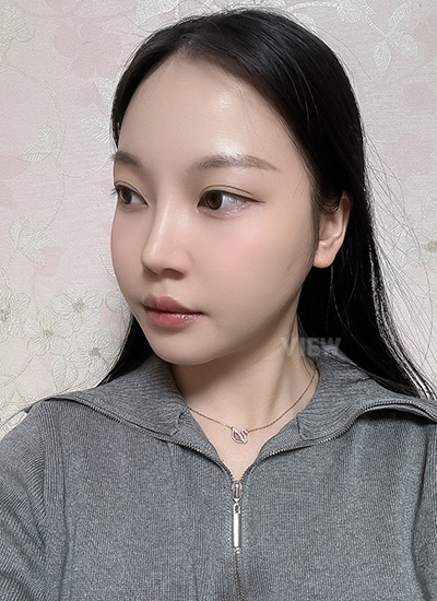 Woman looks more beautiful 3 months after plastic surgery