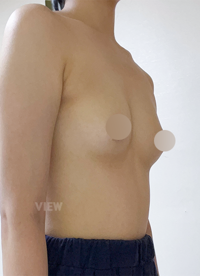 View Plastic Surgery Review, Breast Surgery in Korea, Breast Surgery Consultation, View Plastic Surgery Breast Surgery Review, Breast Augmentation Surgery, Motiva