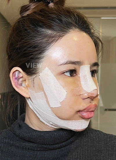 Review Plastic Surgery in Korea, Day 3