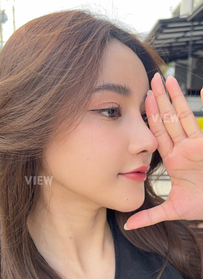  3 Months after rhinoplasty and facial contouring surgery