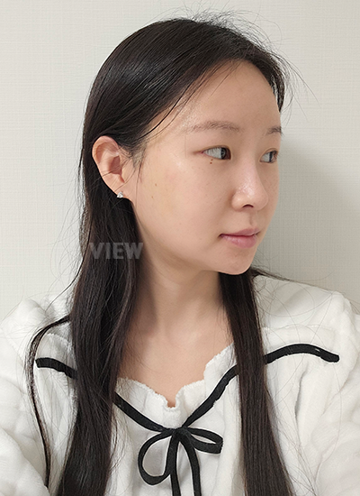 3 weeks after plastic surgery in korea