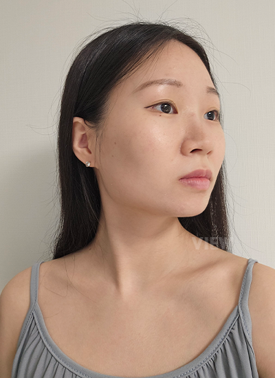 View Plastic Surgery Review, Rhinoplasty in Korea, Rhinoplasty Surgery, Face Contouring in Korea, 