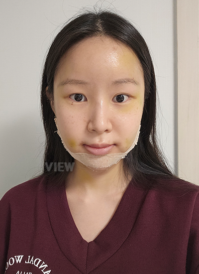 Disinfection After Rhinoplasty