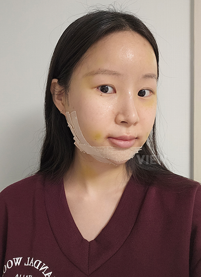 Stitch Removal After Rhinoplasty