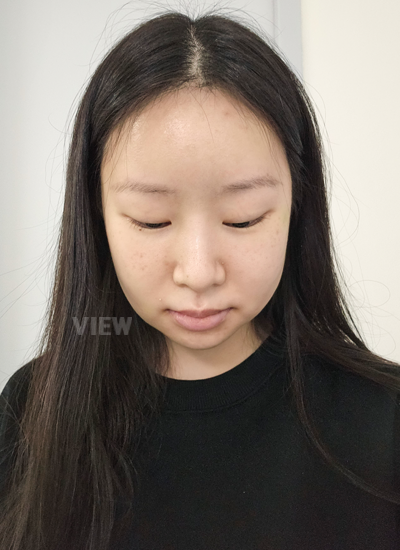 plastic surgery in korea review