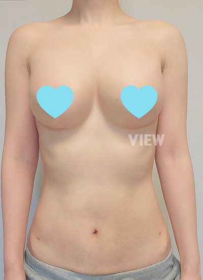 Breast Augmentation Aftercare