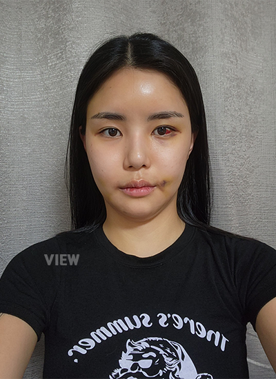 Stitch Removal After Contouring Surgery , Day 7 Fat Grafting Review