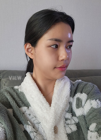 2 Weeks Post-op – Facial Contouring + Fat Grafting 