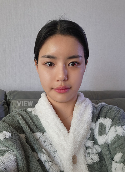 2 Weeks Post-op – Facial Contouring + Fat Grafting 